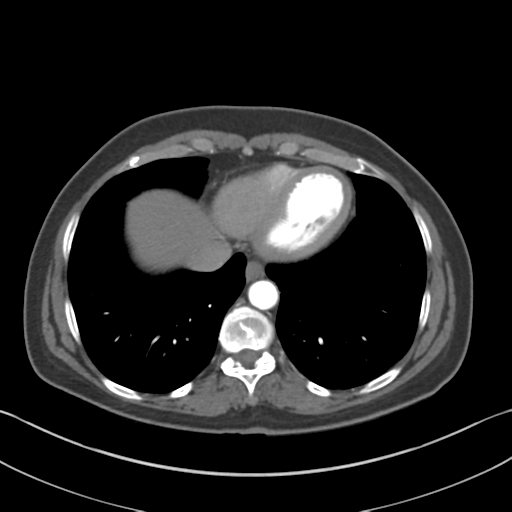 File:Normal CT renal artery angiogram (Radiopaedia 38727-40889 A 5).png