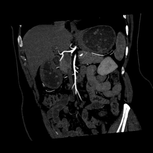 File:Normal CT renal artery angiogram (Radiopaedia 38727-40889 C 7).png