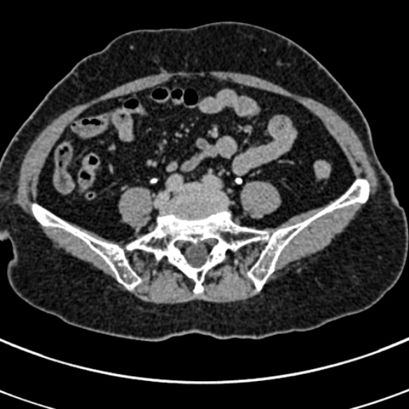 File:Normal CT split bolus study of the renal tract (Radiopaedia 48631-53634 Axial split bolus 192).jpg