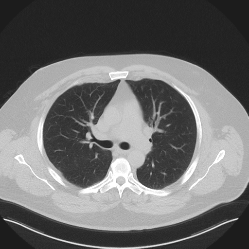 Normal HRCT (Radiopaedia 40797-43458 Axial lung window 24).png