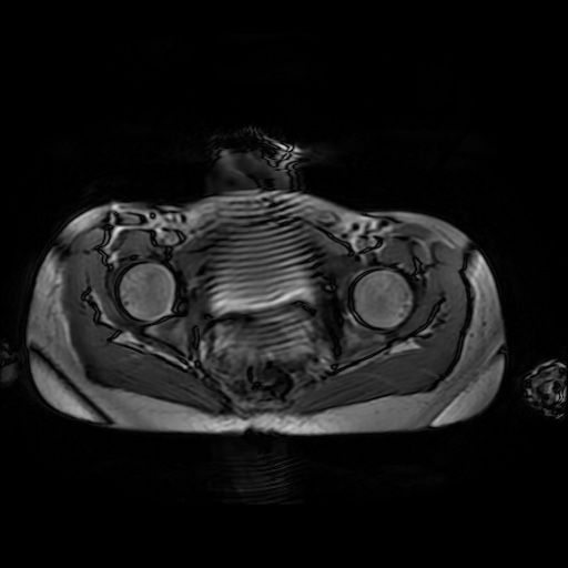 File:Normal MRI abdomen in pregnancy (Radiopaedia 88001-104541 Axial Gradient Echo 53).jpg