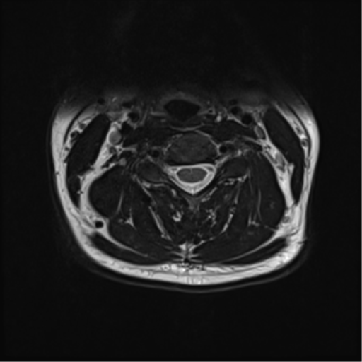 File:Normal MRI cervical spine (infection protocol) (Radiopaedia 53916-60039 Axial T2 25).png