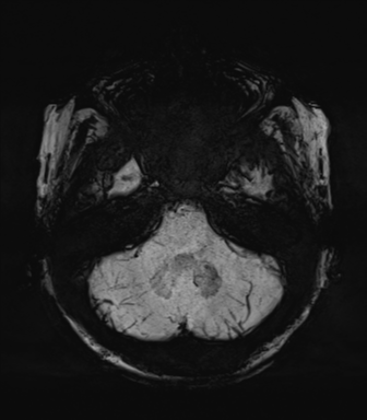Normal MRI internal auditory canal (Radiopaedia 41613-44525 Axial SWI MIP 17).png