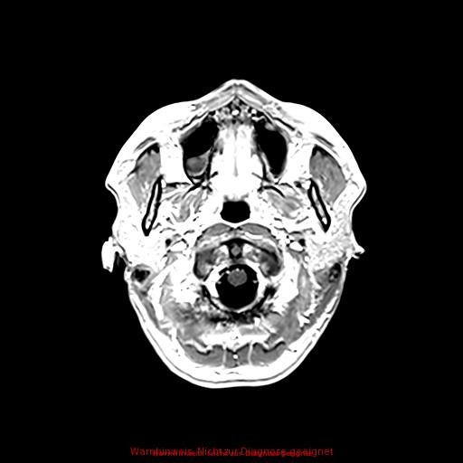 Normal adult brain MRI (non-enhanced and contrast-enhanced) (Radiopaedia 75262-86379 Axial T1 C+ 38).jpg