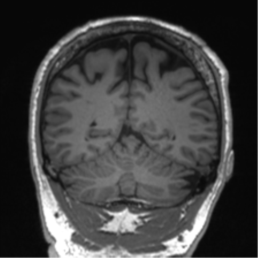 Normal brain MRI (non-focal epilepsy protocol) (Radiopaedia 53917-60040 Coronal T1 22).png