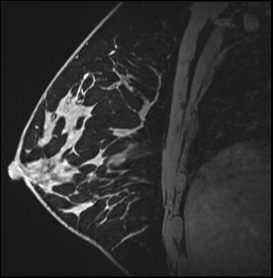 Normal breast MRI - dense breasts (Radiopaedia 80454-93850 I 114).jpg