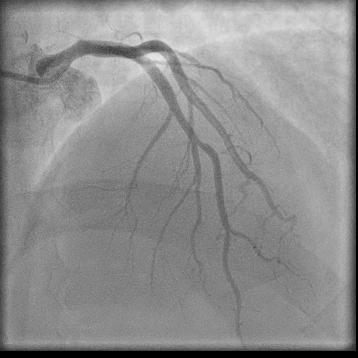 Normal coronary angiogram (DSA) (Radiopaedia 63081-71571 E 30).jpg