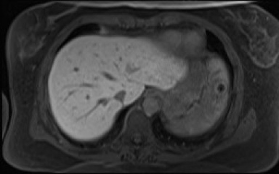 File:Normal hepatobiliary phase liver MRI (Radiopaedia 58968-66230 A 21).jpg