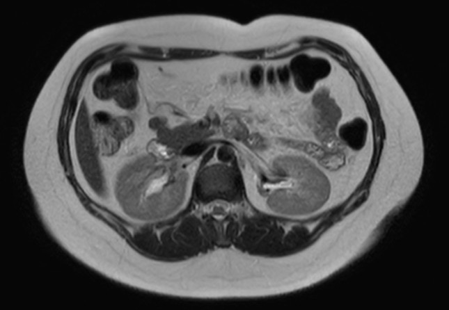 File:Normal liver MRI with Gadolinium (Radiopaedia 58913-66163 Axial T2 14).jpg