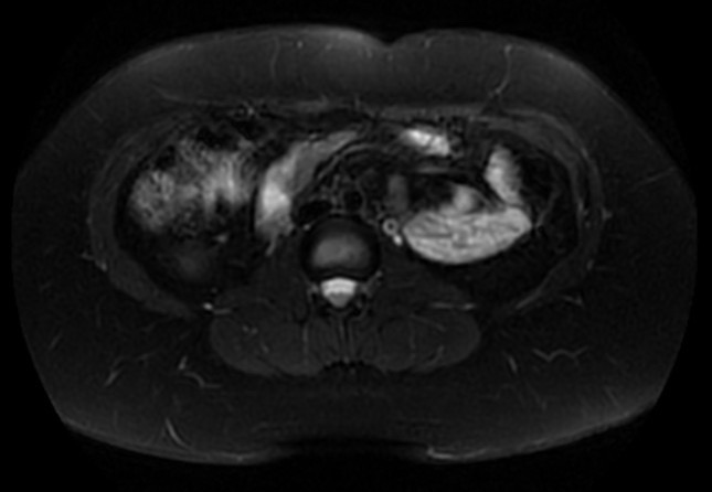 File:Normal liver MRI with Gadolinium (Radiopaedia 58913-66163 Axial T2 fat sat 11).jpg