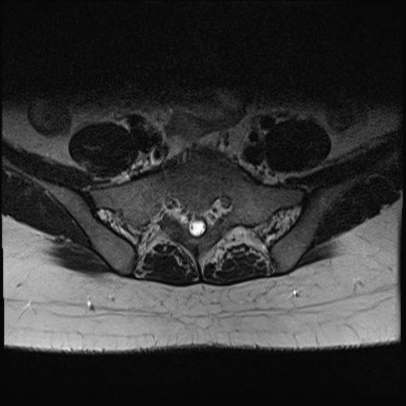 File:Normal lumbar spine MRI- 3 T (Radiopaedia 53280-59250 Axial T2 32).jpg