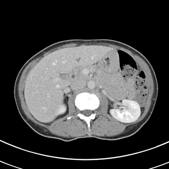 File:Normal multiphase CT liver (Radiopaedia 38026-39996 C 30).jpg