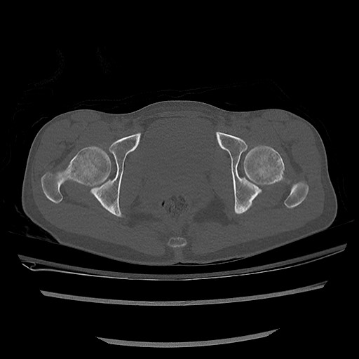 Normal pelvis CT (Radiopaedia 51471-57236 Axial bone window 77).jpg