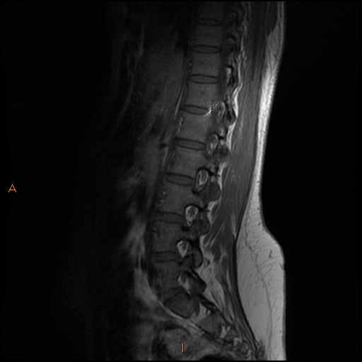 File:Normal spine MRI (Radiopaedia 77323-89408 Sagittal T1 5).jpg