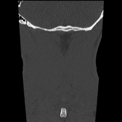 File:Normal trauma cervical spine (Radiopaedia 41017-43760 Coronal bone window 46).png