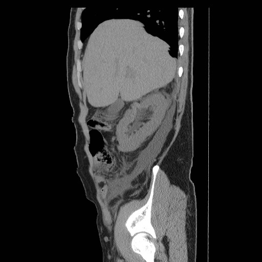 File:Obstructed kidney with perinephric urinoma (Radiopaedia 26889-27066 B 9).jpg