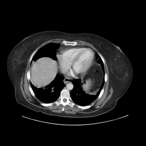 Obstructive distal colonic adenocarcinoma causing cecal perforation (Radiopaedia 86830-102989 A 24).jpg