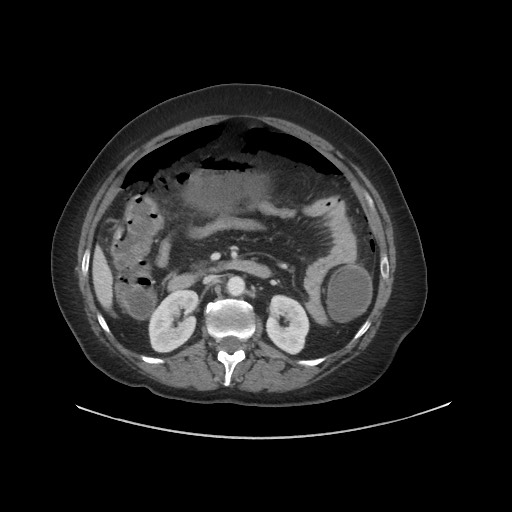 Obstructive distal colonic adenocarcinoma causing cecal perforation (Radiopaedia 86830-102989 A 86).jpg