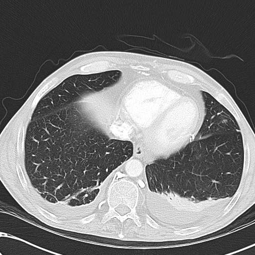 File:Obstructive superior vena cava tumor thrombus (Radiopaedia 28046-28306 Axial lung window 43).jpg