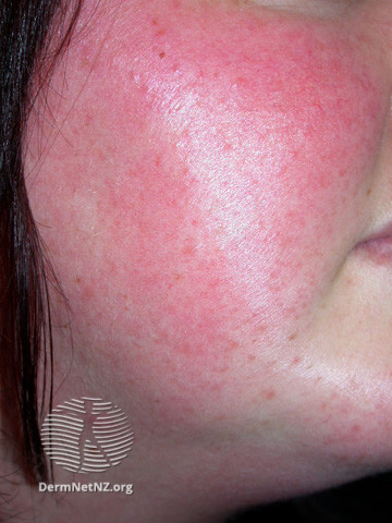 Rosacea (DermNet NZ acne-red-face-3623).jpg