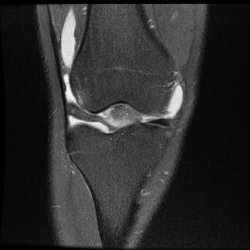 File:ACL acute full thickness tear - deep lateral femoral sulcus sign (Radiopaedia 38594-40740 Coronal PD fat sat 8).jpg