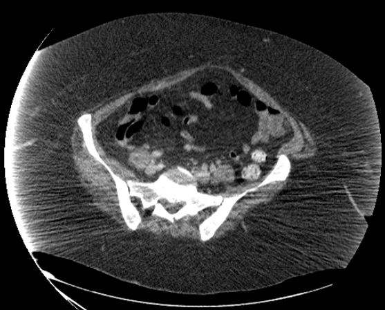 File:Abdominal abscess - pre and post percutaneous drainage (Radiopaedia 60209-67816 Axial 76).png