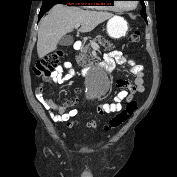 File:Abdominal aortic aneurysm (Radiopaedia 10122-10660 Coronal C+ portal venous phase 8).jpg