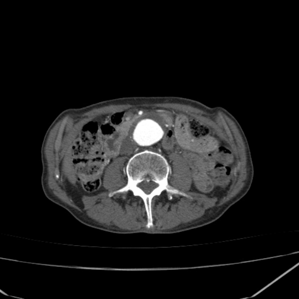 Abdominal aortic aneurysm (Radiopaedia 23703-23856 Axial C+ arterial phase 41).jpg
