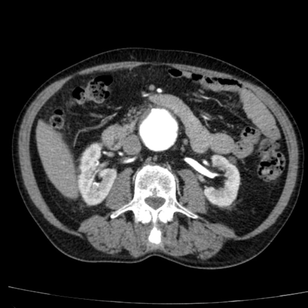 Abdominal aortic aneurysm (Radiopaedia 29248-29660 Axial C+ arterial phase 39).jpg