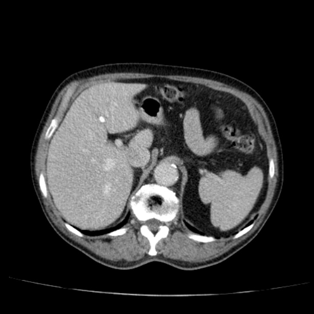 Abdominal aortic aneurysm (Radiopaedia 29248-29660 Axial C+ portal venous phase 16).jpg