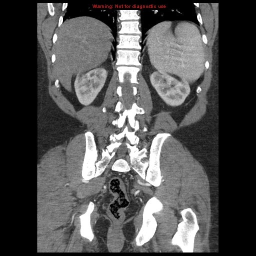 Abdominal aortic aneurysm (Radiopaedia 8190-9038 Coronal C+ arterial phase 96).jpg