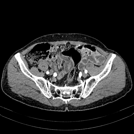 Abdominal aortic aneurysm (Radiopaedia 83581-98689 Axial C+ arterial phase 92).jpg
