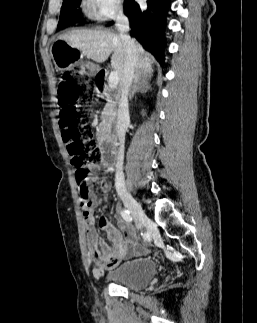 Abdominal aortic aneurysm (Radiopaedia 83581-98689 Sagittal C+ portal venous phase 25).jpg