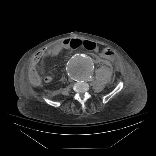 Abdominal aortic aneurysm - impending rupture (Radiopaedia 19233-19247 Axial non-contrast 105).jpg