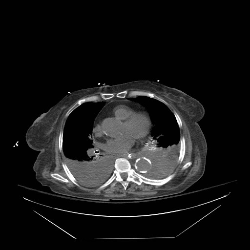Abdominal aortic aneurysm - impending rupture (Radiopaedia 19233-19247 Axial non-contrast 9).jpg