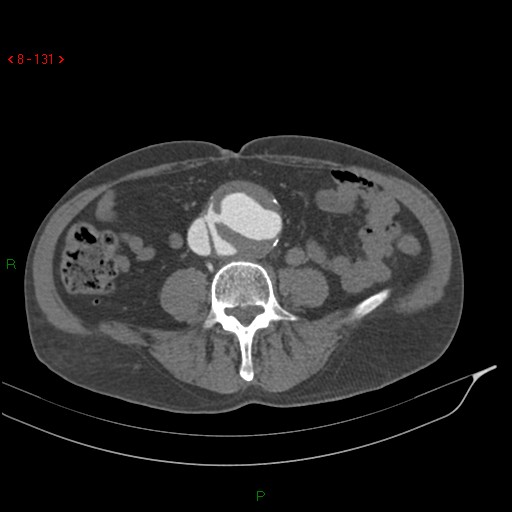 File:Abdominal aortic aneurysm rupture with aortocaval fistula (Radiopaedia 14897-14841 Axial C+ arterial phase 131).jpg