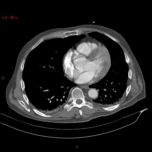 Abdominal aortic aneurysm rupture with aortocaval fistula (Radiopaedia 14897-14841 Axial C+ arterial phase 45).jpg
