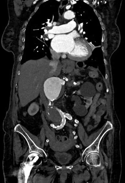 Abdominal aortic aneurysm with thrombus fissuration (Radiopaedia 73192-83919 Coronal C+ arterial phase 39).jpg