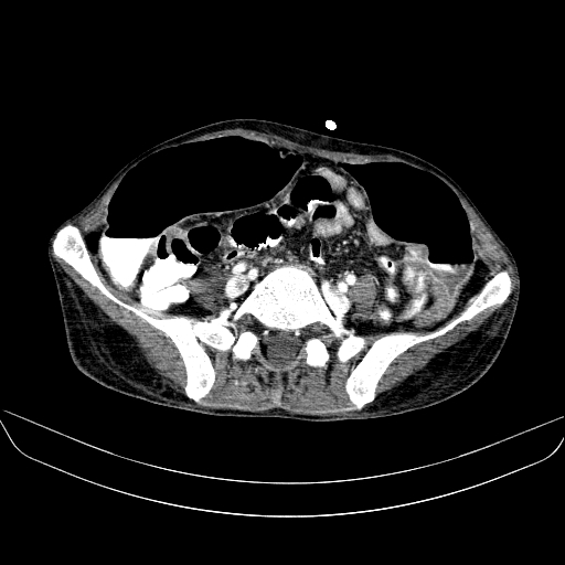 File:Abdominal collection due to previous cecal perforation (Radiopaedia 80831-94320 Axial C+ portal venous phase 140).jpg