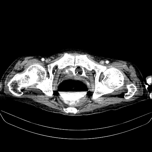 File:Abdominal collection due to previous cecal perforation (Radiopaedia 80831-94320 Axial C+ portal venous phase 201).jpg