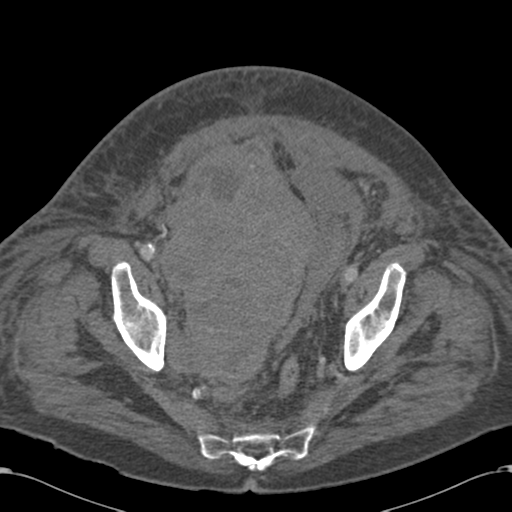 File:Abdominal hematoma (Radiopaedia 33614-34715 Axial C+ portal venous phase 113).png