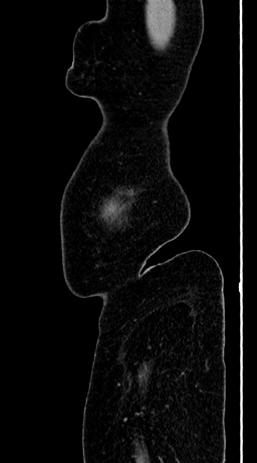 Abdominal hydatid disease (Radiopaedia 68223-77737 Sagittal C+ portal venous phase 73).jpg