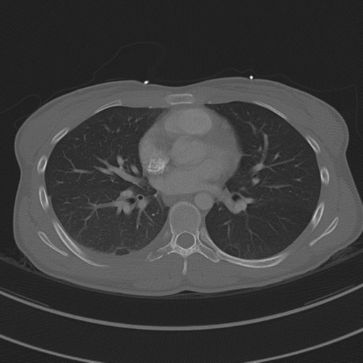 File:Abdominal multi-trauma - devascularised kidney and liver, spleen and pancreatic lacerations (Radiopaedia 34984-36486 I 47).png