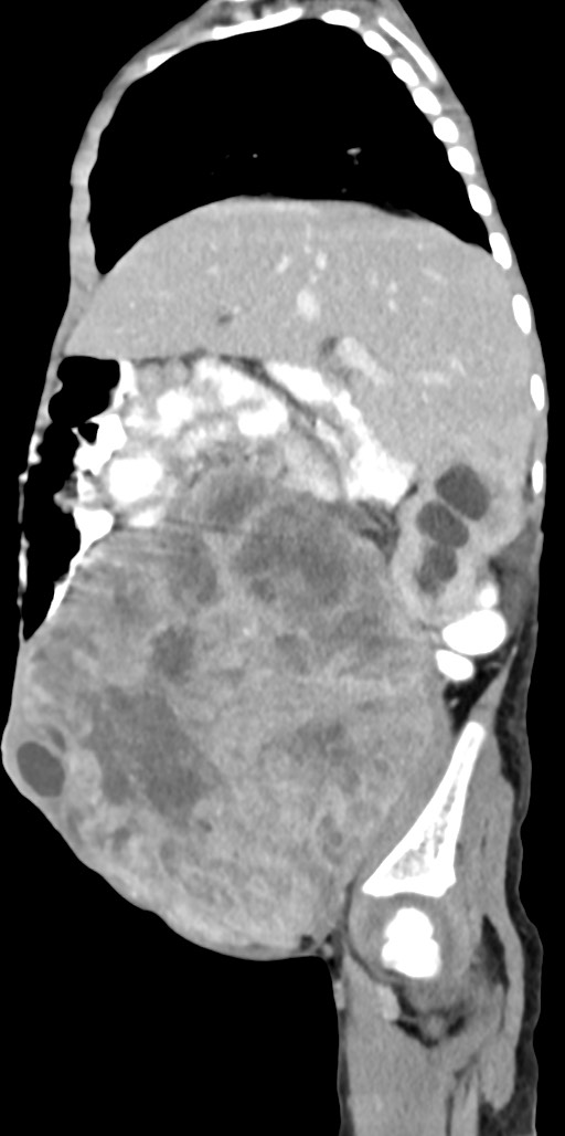 Abdominopelvic rhabdomyosarcoma (Radiopaedia 78356-90984 Sagittal C+ portal venous phase 67).jpg