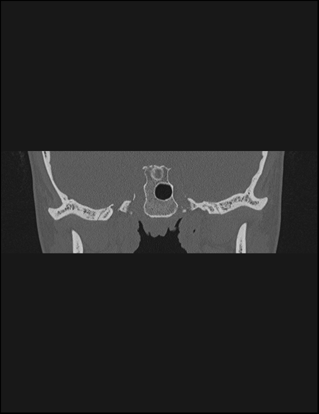 Aberrant right internal carotid artery (Radiopaedia 65191-74198 Coronal non-contrast 15).jpg