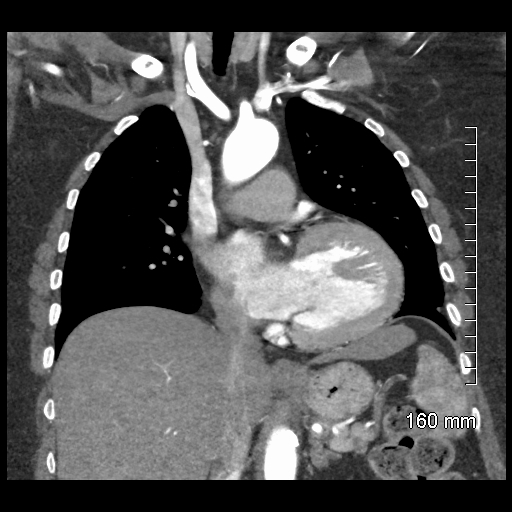 Aberrant right subclavian artery stenosis (Radiopaedia 52656-58670 B 42).jpg