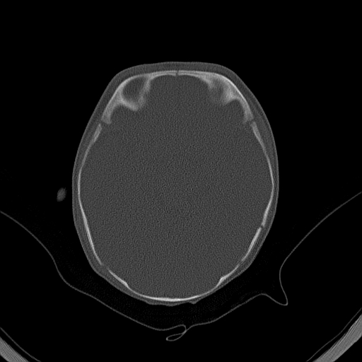 File:Accessory intraparietal suture (Radiopaedia 50584-56020 Axial bone window 17).jpg