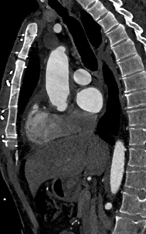 Accessory left atrial appendage (Radiopaedia 81987-95968 Sagittal C+ arterial phase 42).jpg