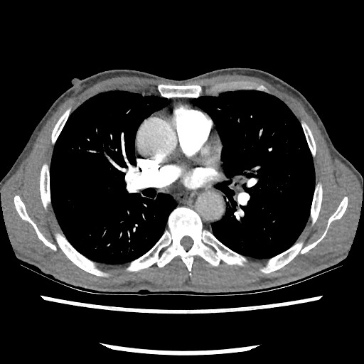 Accessory left horizontal fissure with lingular pneumonia (Radiopaedia 53763-59843 Axial C+ CTPA 47).jpg