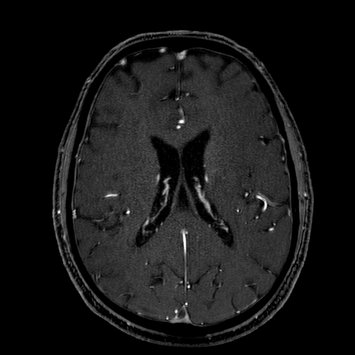 Accessory middle cerebral artery (Radiopaedia 73114-83828 Axial MRA 128).jpg